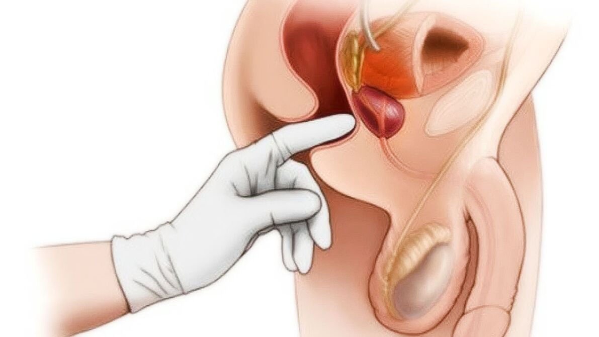 Masaža prostate