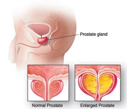 Normalna i upaljena prostata