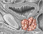 Kronični prostatis