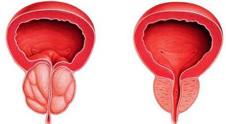 Razlika bolesnih i zdravih prostate