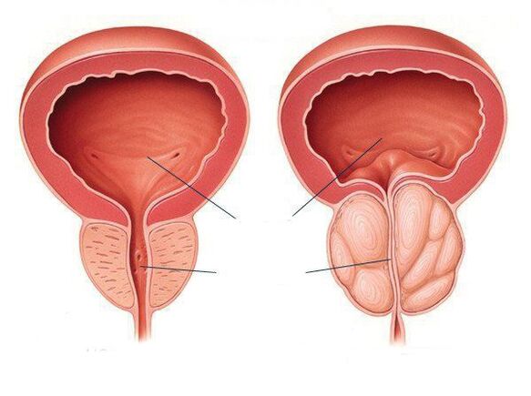 normalna upala prostate i prostate